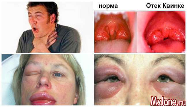 Алергія на метал: не тільки косметична проблема...