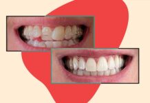 Invisalign: Повне Посібник Перед Початком